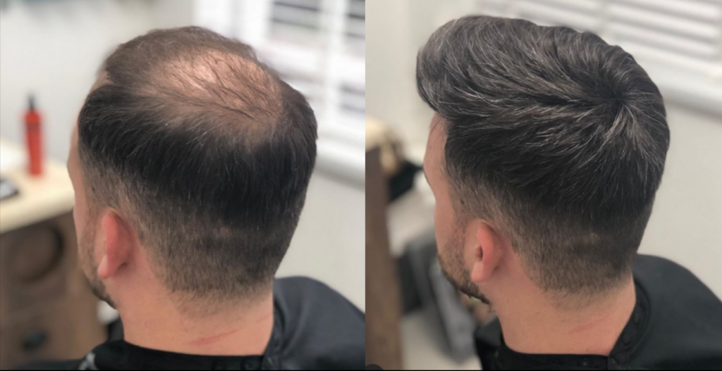 Male Hair Systems - Consultation